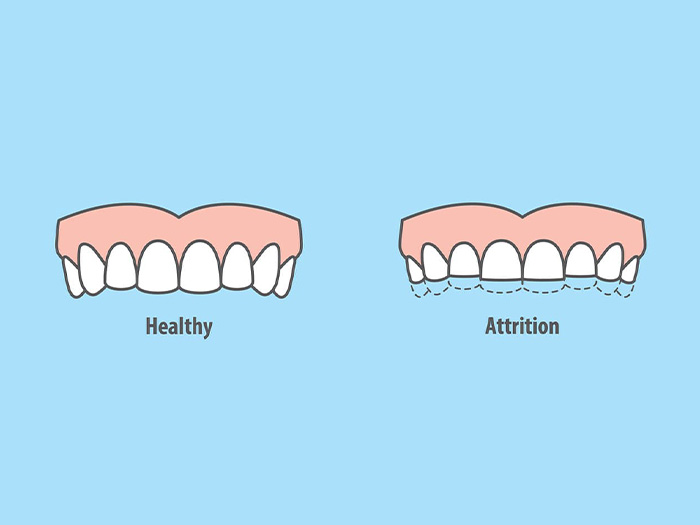 Bruxism before & after mewing progression